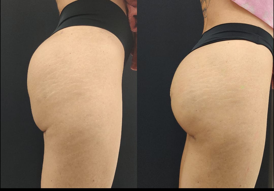 Antes E Depois Da Gluteoplastia Como Fica O Resultado Dr Jorge