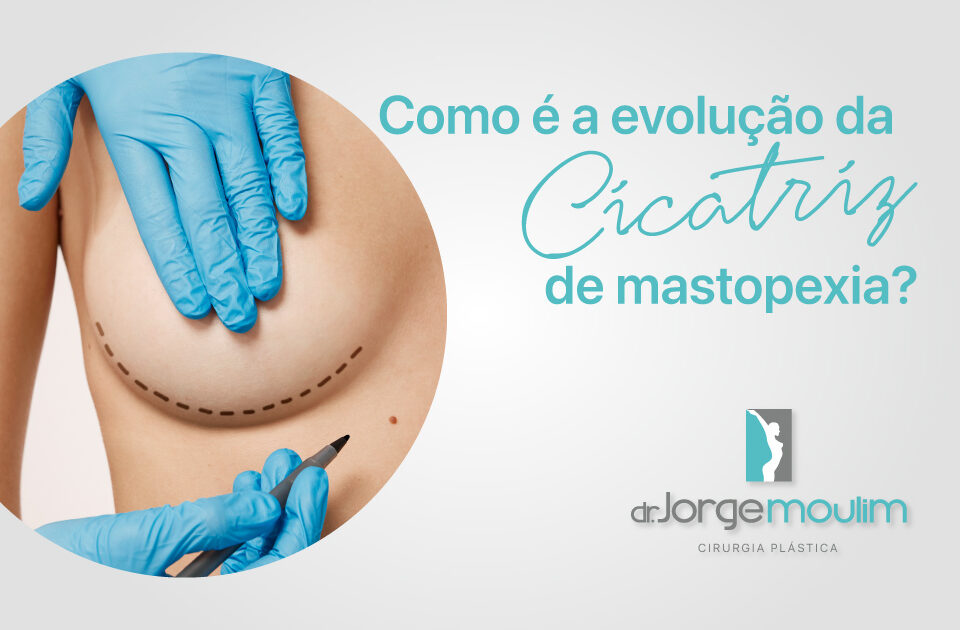 Dr Jorge Moulim - Cirurgia de Mama - Cirurgia Plástica - Como é a evolução da cicatriz de mastopexia?