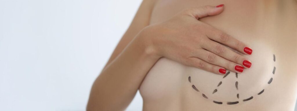 cicatriz da mamoplastia de aumento