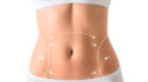abdominoplastia