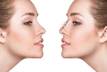 Resultados naturais na rinoplastia: técnica, planejamento e proporção