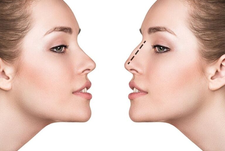 cirurgia de rinoplastia