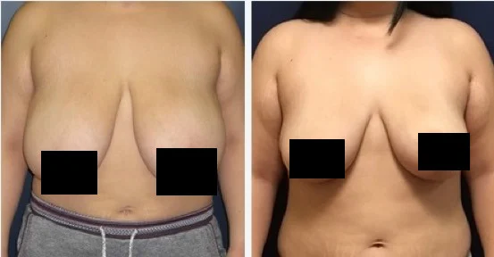 mamoplastia redutora antes e depois resultado