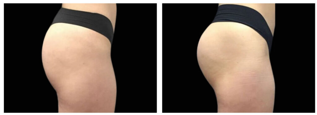antes e depois da gluteoplastia