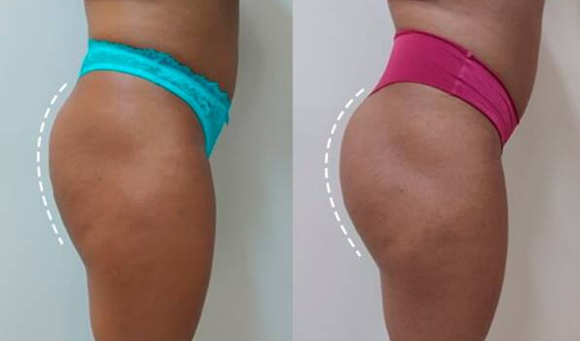 antes e depois da gluteoplastia