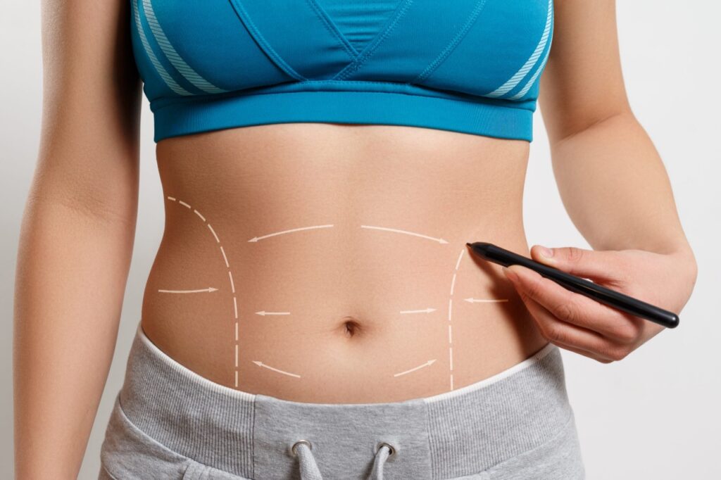 cicatriz da abdominoplastia