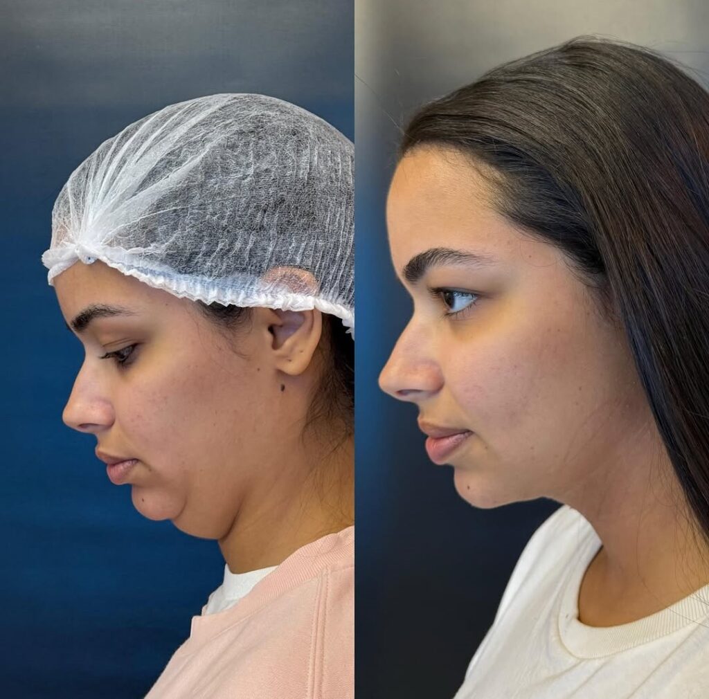 resultado de Lipo de Papada