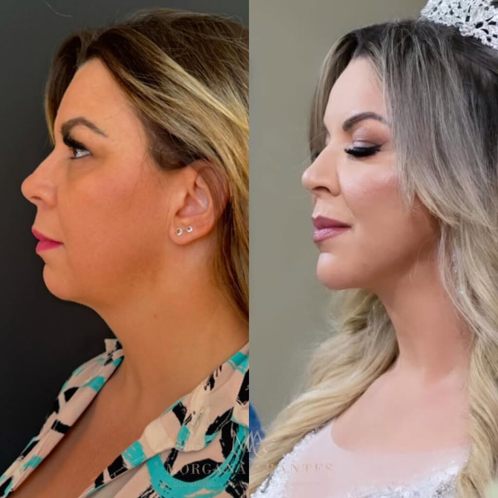 resultado de Lipoaspiração de Papada