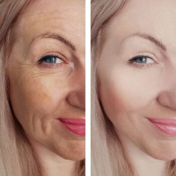 Botox no Rosto: Antes e Depois