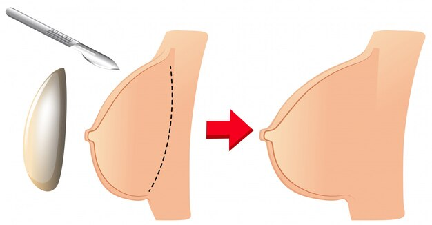 aumentar os seios com silicone