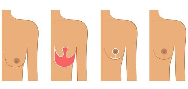 tipos de cirurgia nos seios