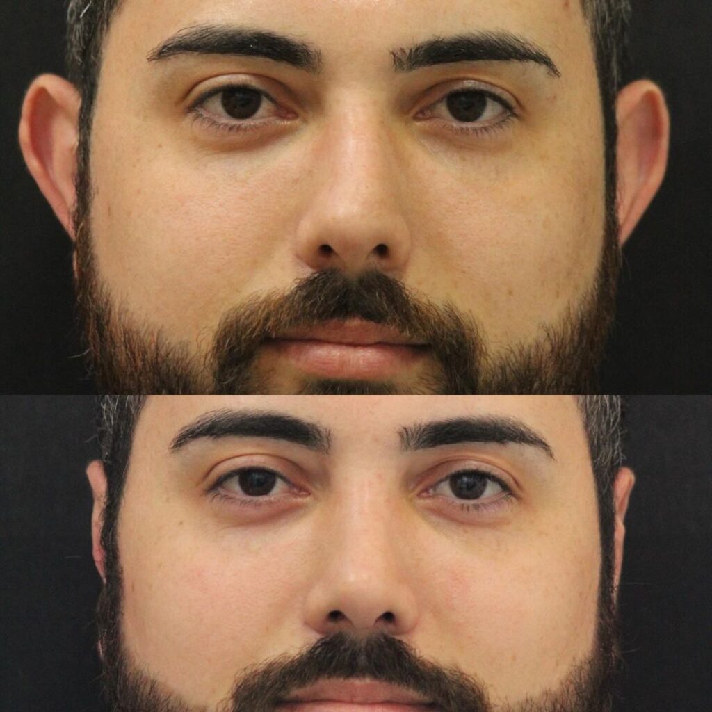 resultado otoplastia antes e depois