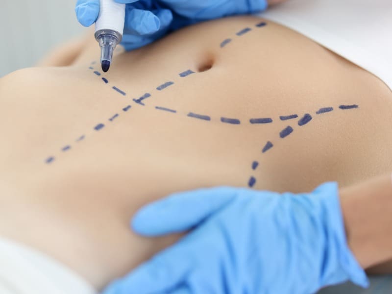 tipos-de-cicatrizes-da-abdominoplastia