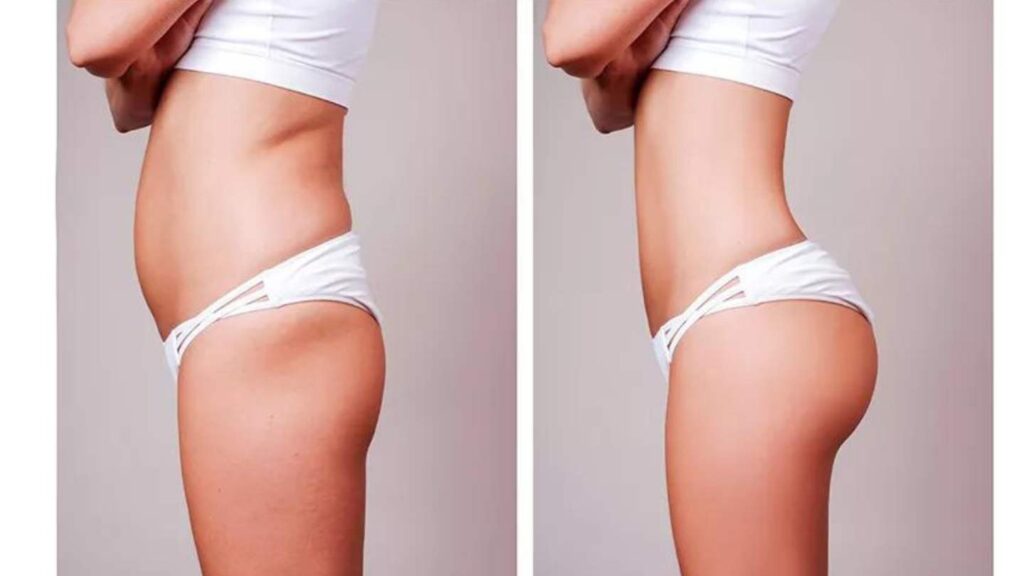 Lipoescultura Antes e Depois bum bum