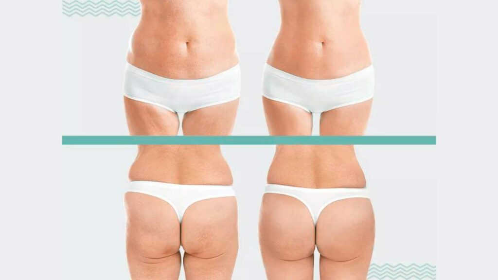 Lipoescultura Antes e Depois gluteos