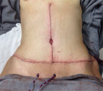 Abdominoplastia em âncora: Saiba tudo sobre esse procedimento cirúrgico