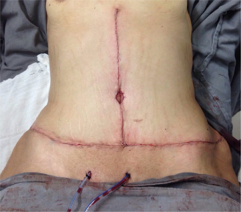 Abdominoplastia em âncora - foto real