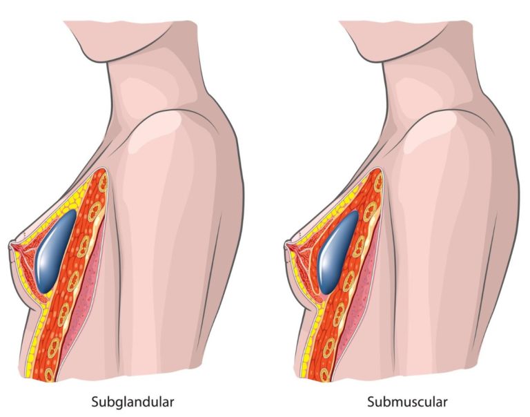 silicone baixo de musculo vs por cima do musculo