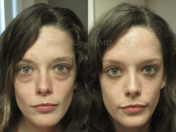 Blefaroplastia: Antes, Durante e Depois da Cirurgia