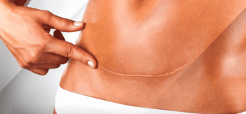 Cicatriz em Pele Negra e Morena: Guia simples