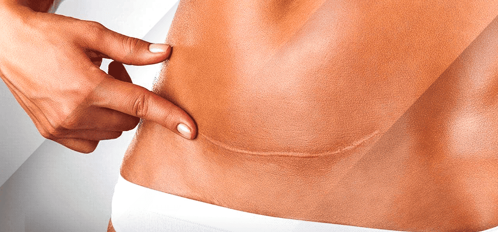 cicatriz cirurgia pele negra