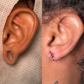 Cirurgia plástica para orelha rasgada