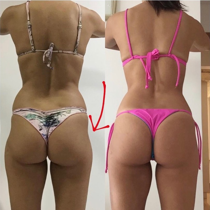 Hip Dips - antes e depois