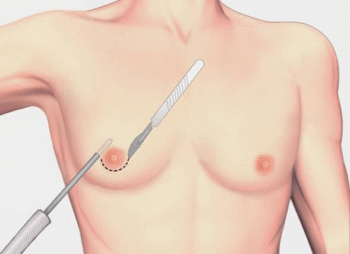 Cicatriz na ginecomastia: onde fica e por que?