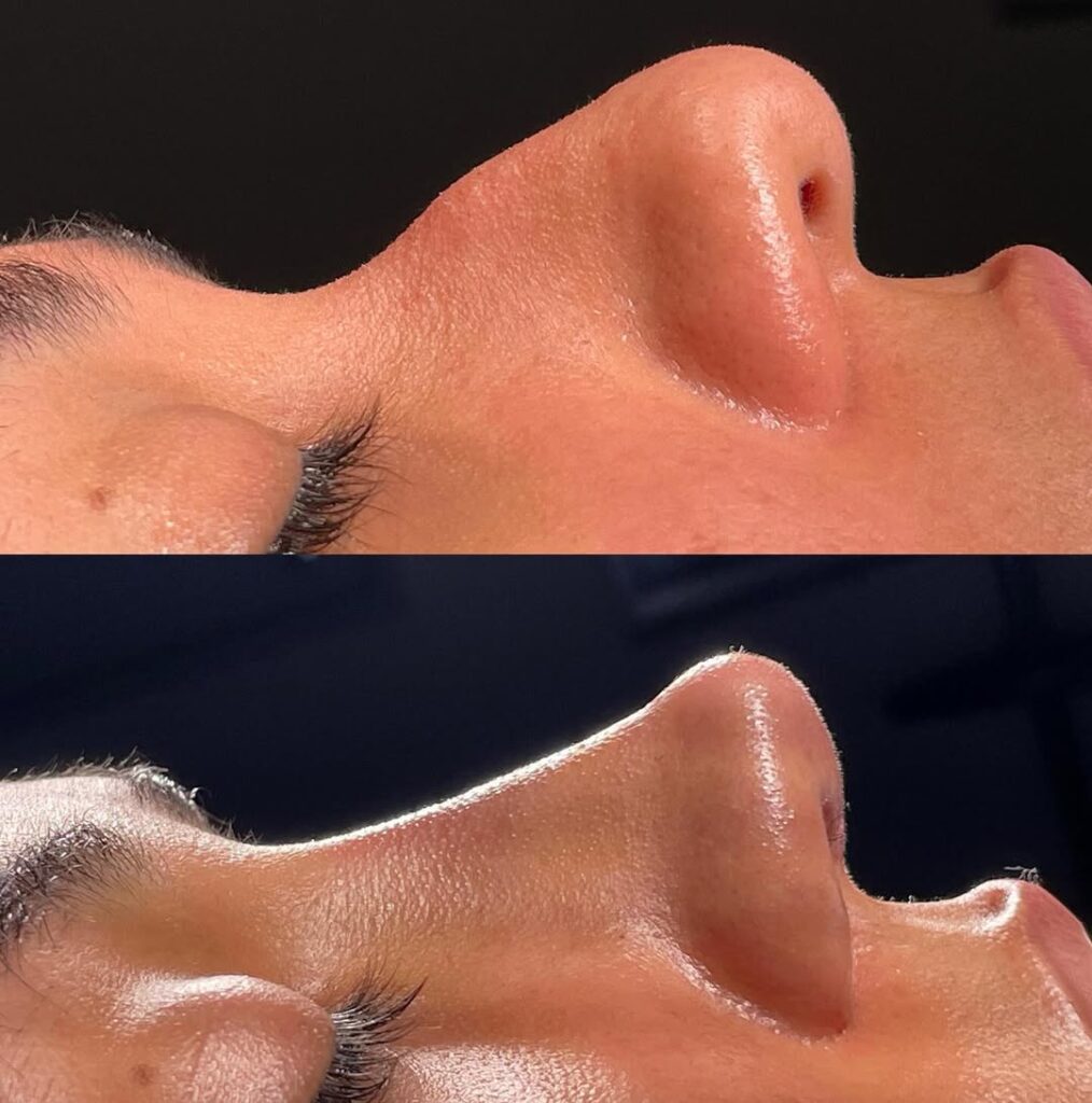 Rinoplastia para giba nasal