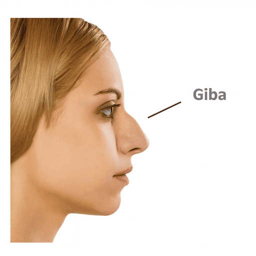 giba nasal o que é