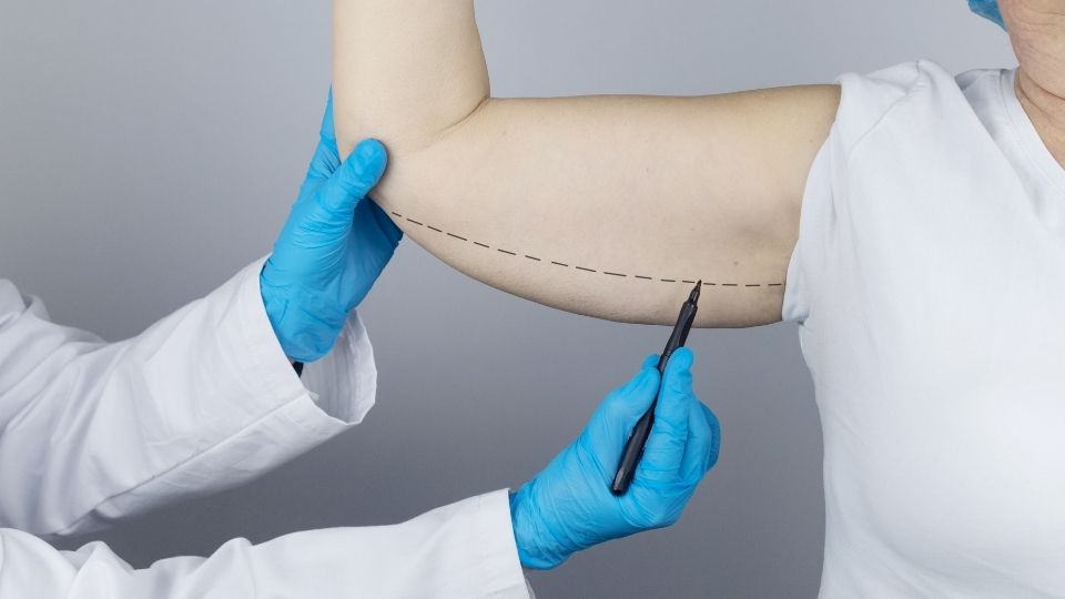 braquioplastia marcações no braço
