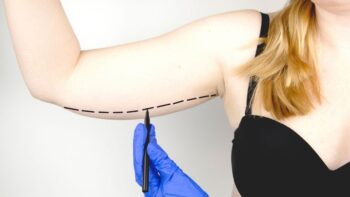 Braquioplastia vale a pena para quem perdeu muito peso?