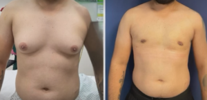 resultado da cirurgia de ginecomastia (1)