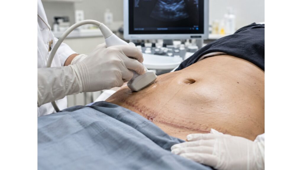 Seroma após abdominoplastia