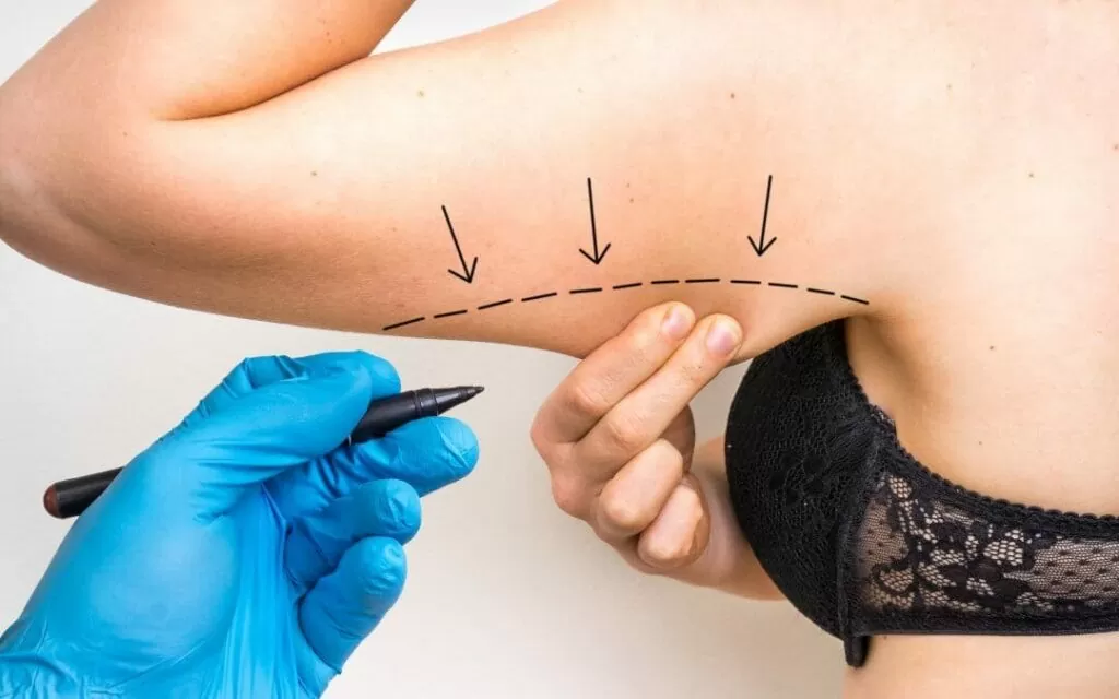 Braquioplastia