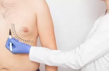 Quanto custa uma cirurgia de ginecomastia? Descubra os fatores que influenciam no preço