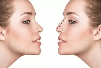 Resultados naturais na rinoplastia: técnica, planejamento e proporção