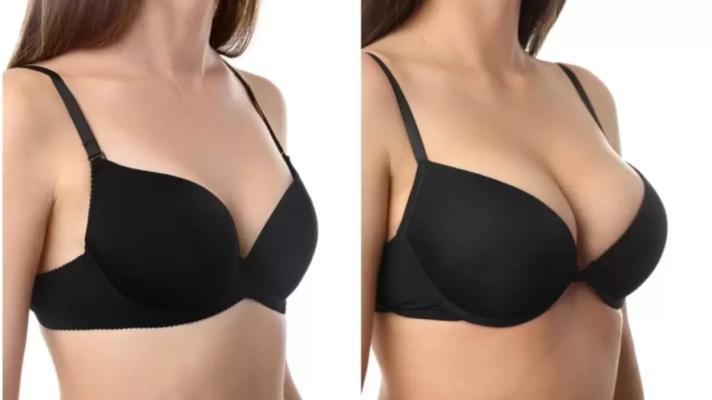 mamoplastia redutora na adolescência 