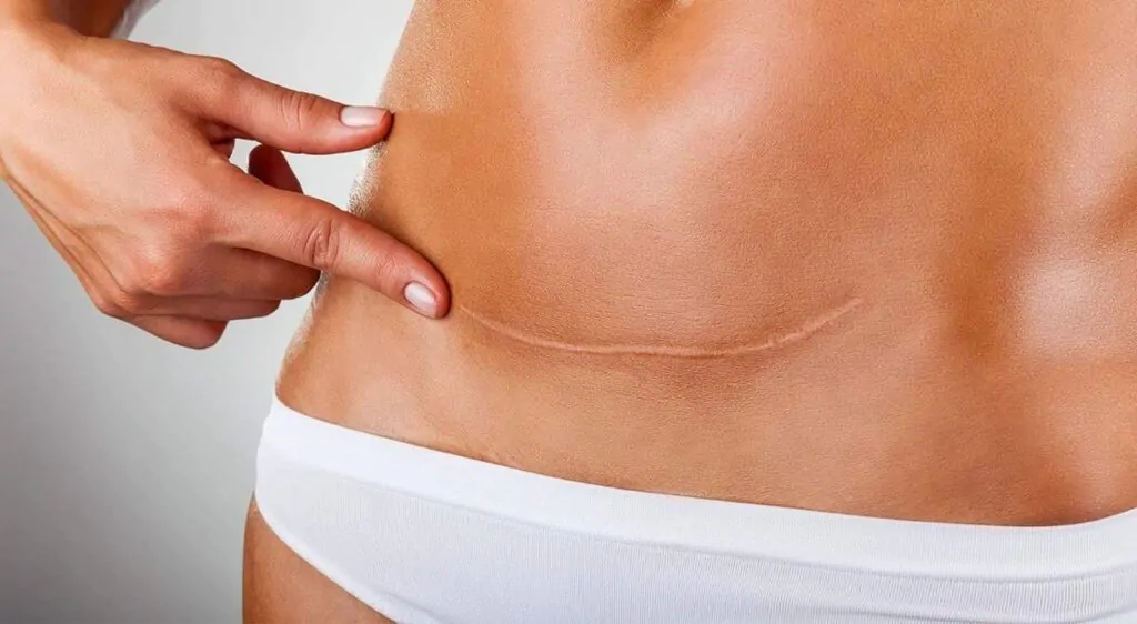 cicatriz da abdominoplastia