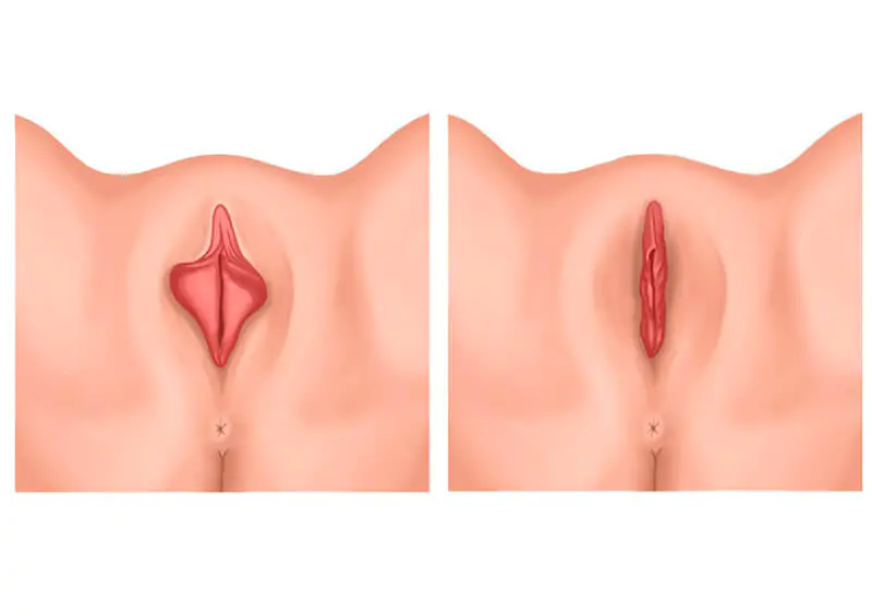 ninfoplastia cirurgia intima feminina no pequenos labios