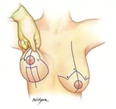 mastoplastia de aumento