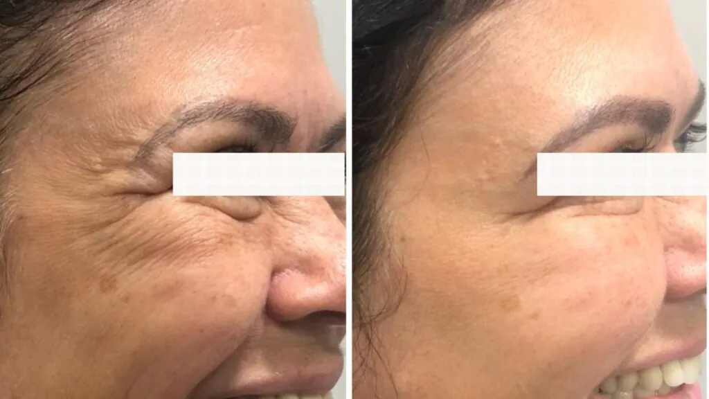 Botox antes e depois – confira casos reais de pacientes