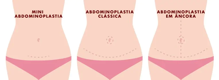 tipos-de-abdominoplastia