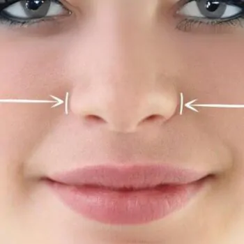 Rinoplastia para Nariz de Batata: Refinando a Estética