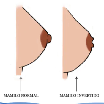 Mamilo invertido: O que é e como corrigir?