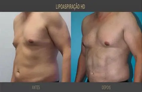 resultado Lipo LAD homem