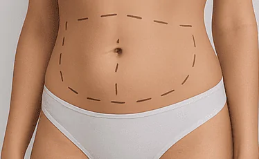 Lipo Sem Corte - resultado