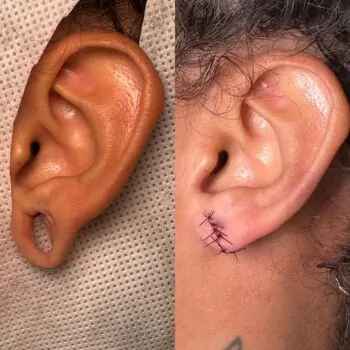 Cirurgia plástica para orelha rasgada