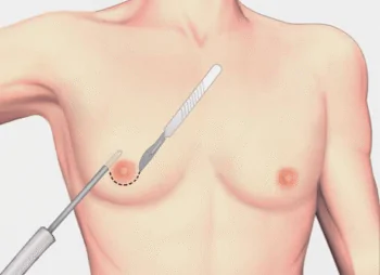 Cicatriz na ginecomastia: onde fica e por que?